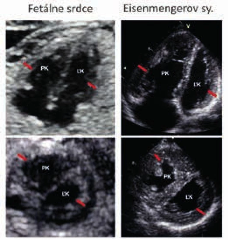 Porovnanie echokardiografického obrazu fetálneho srdca a srdca pri Eisenmengerovom syndróme