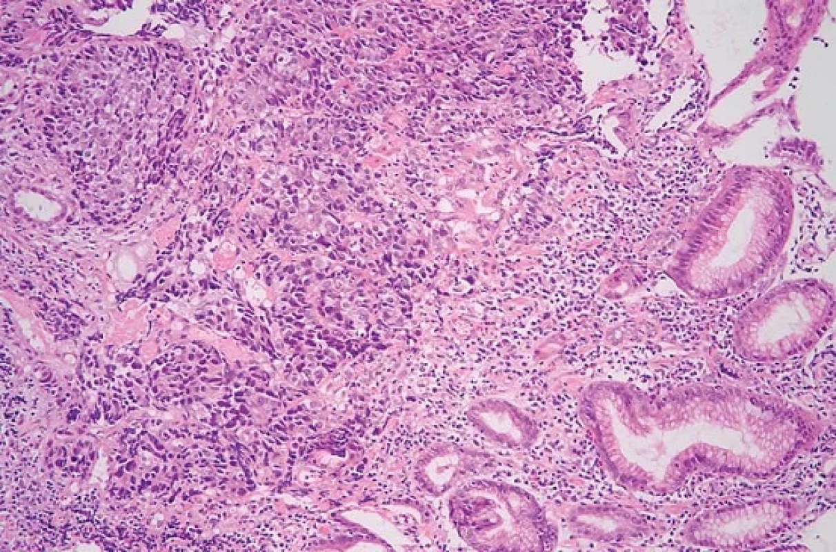Solidně rostoucí adenokarcinom ve sliznici žaludku (hematoxylin-eozin, původní zvětšení 200×).
Fig. 3. Solid adenocarcinoma in gastric mucosa (haematoxylin-eosin, original magnification ×200).