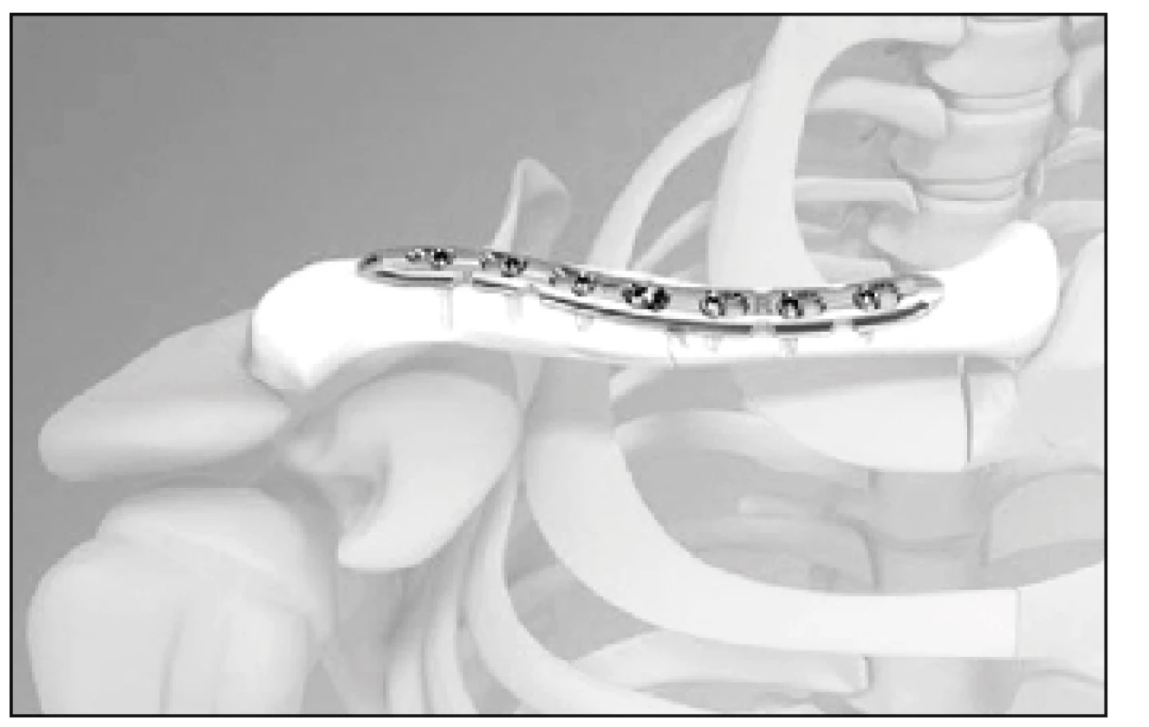 Ukázky možností použití úhlově stabilních dlah pro zlomeniny střední diafýzy klíční kosti (materiál fy DePuy-Synthes)