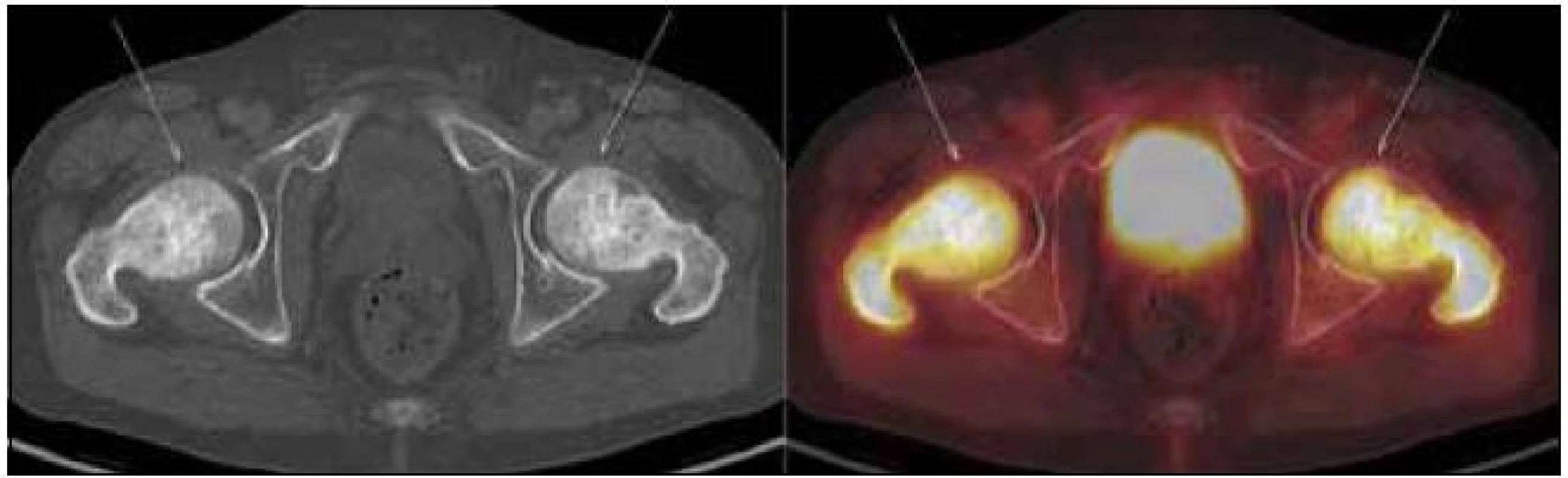 PET-CT zobrazení kyčle a femurů. Oba femury mají nepravidelnou, převážně sklerotickou strukturu spongiózy s osteolytickými okrsky, v těchto místech i jasný hypermetabolizmus glukózy (označeno šipkami). Aktivita v močovém měchýři fyziologická při vylučování radiofarmaka.
