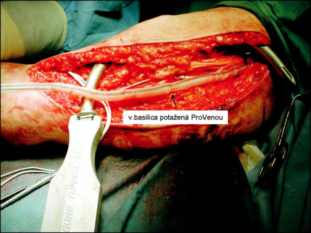 Aplikace zevní protézy na basilickou žílu
Fig. 3. Application of the external prosthesis to the basilic vein