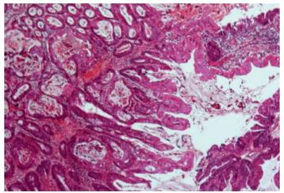 Urachal adenocarcinoma with relatively well differentiated appearance.