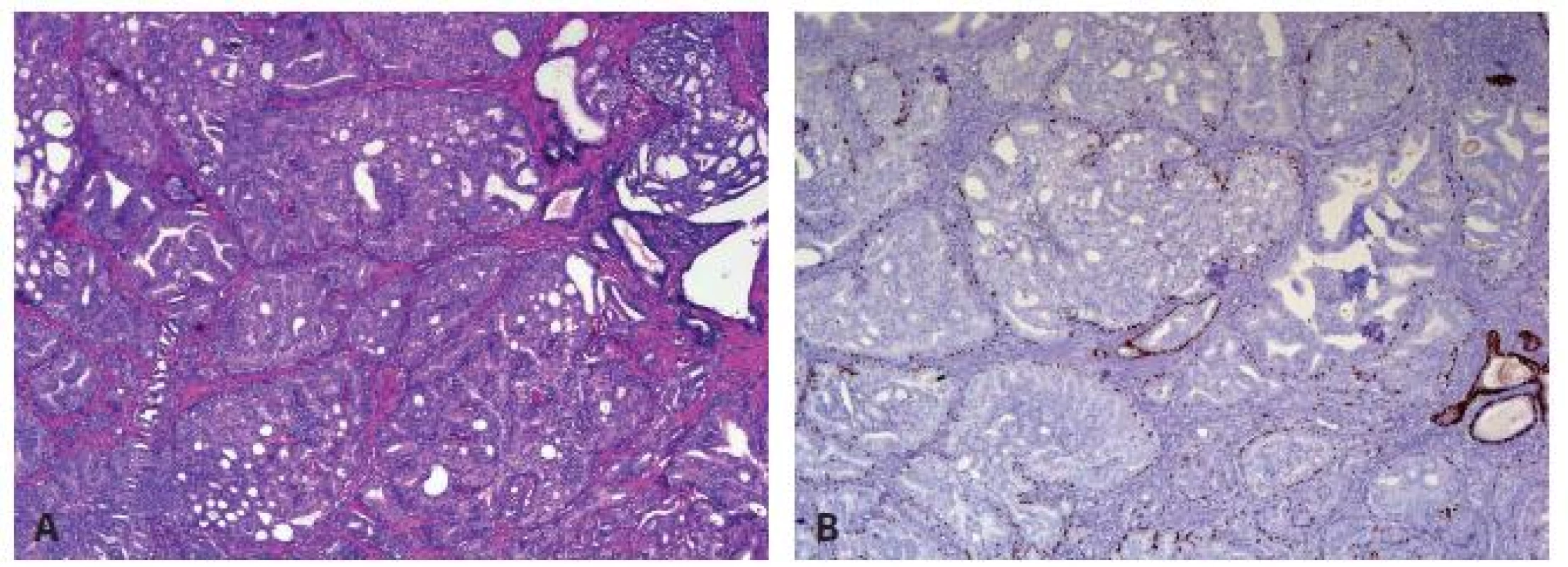 Intraductal carcinoma of the prostate presents as marked expansile growth of prostate cancer cells (A) within preexisting prostate ducts and acini (A) with at least focally preserved basal cells on P63 immunostain (B).