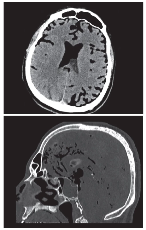 CT vyšetření při příjmu: pneumocefalus
Fig. 1: CT scan after admission: pneumocephalus