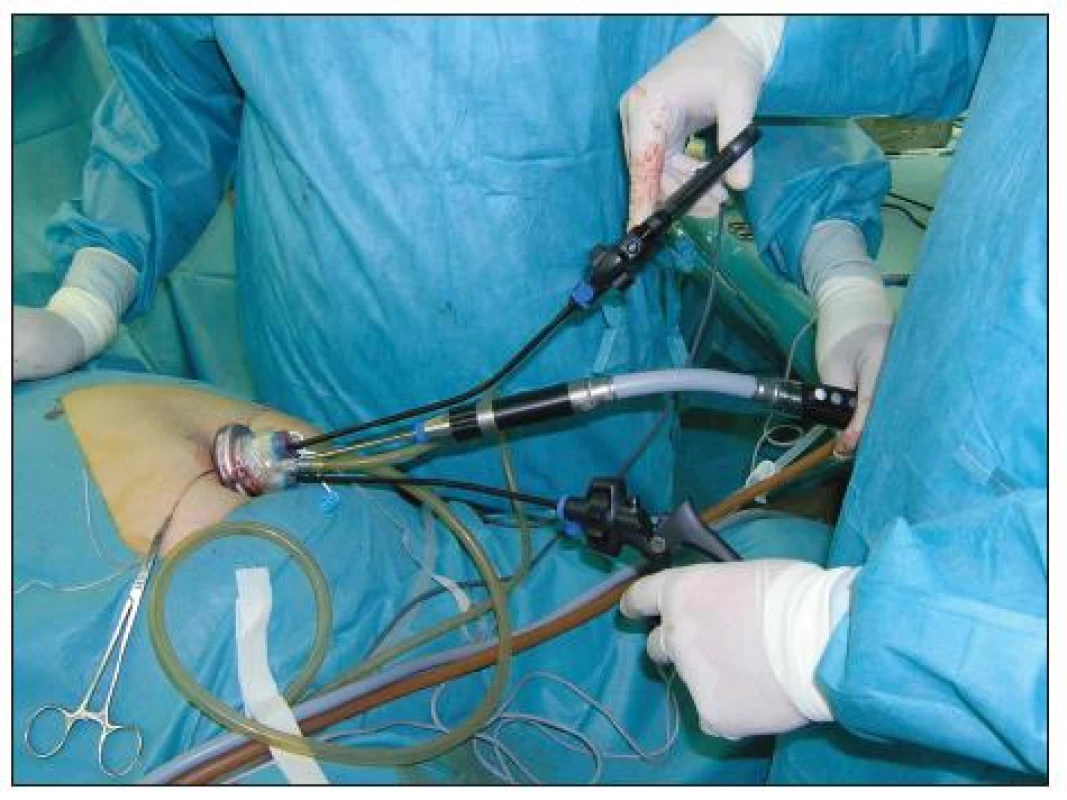 Asymetrické endoskopické nástroje (LESS)
Fig. 3. Asymetric endoscopic instruments (LESS)