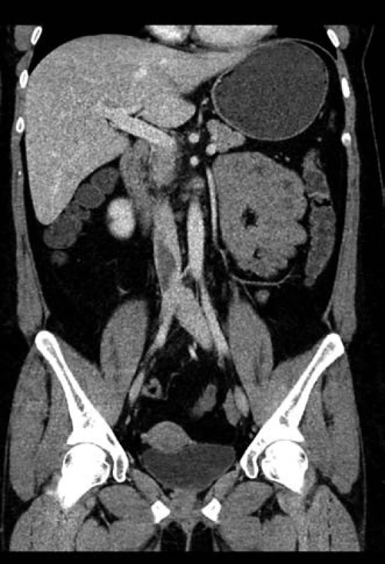 CT snímek – nález mimo trávicí trubici.