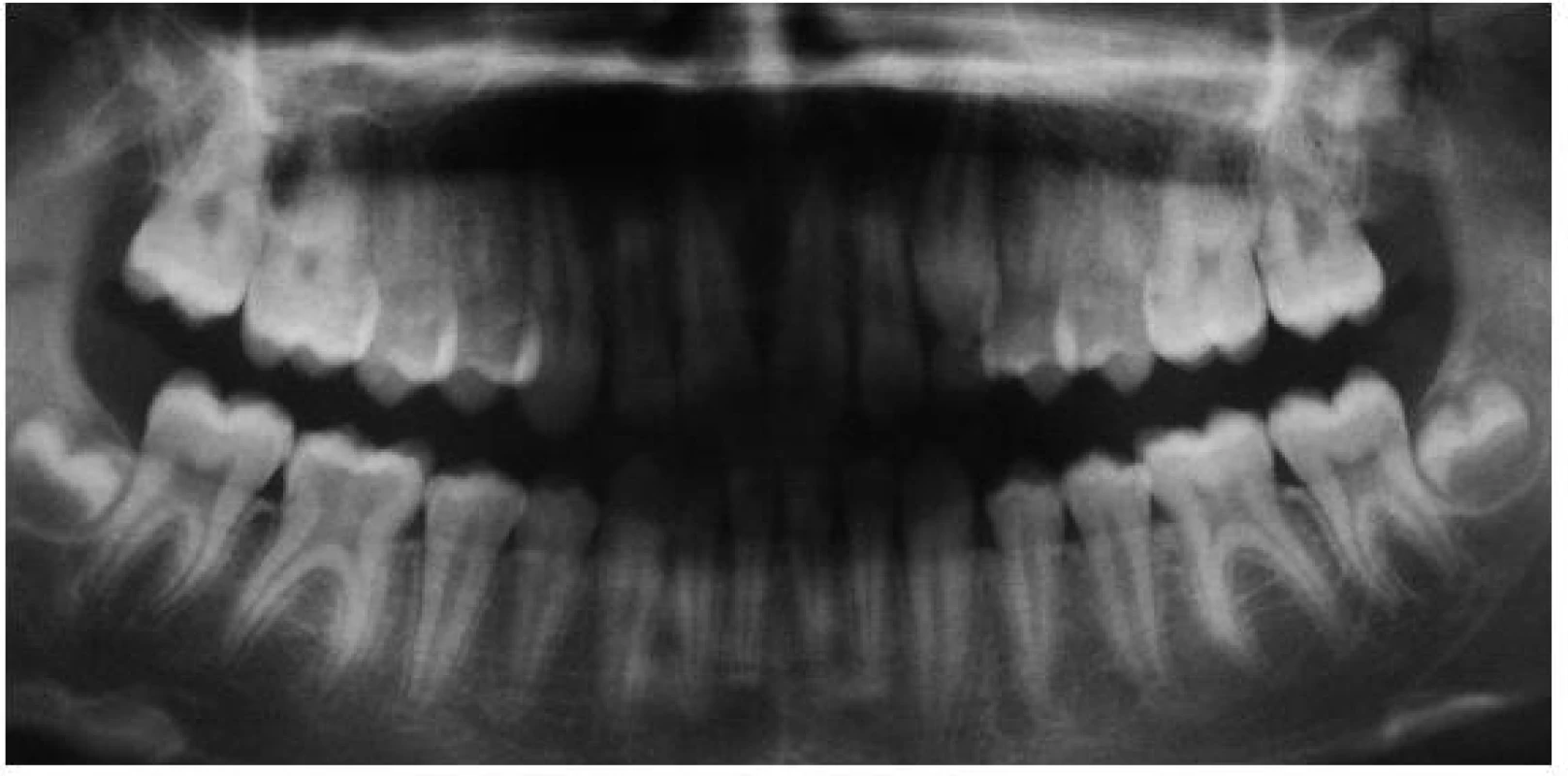 Ortopantomogram před extrakcí zubu 46