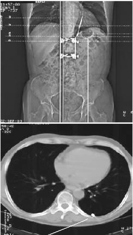 CT obraz cizího tělesa v pleurální dutině
Fig. 3. A CT view of a foreign body in the pleural cavity