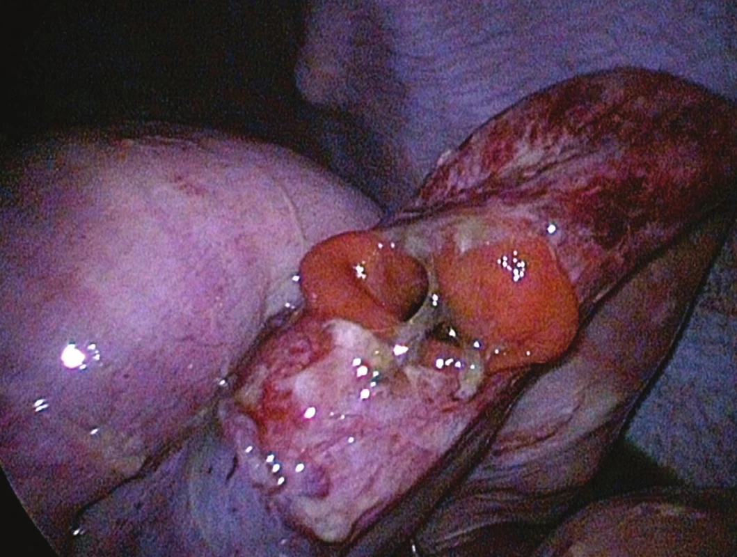 A large volume of cloudy brown fluid with intestine contains, 25 cm of Treitz ligament the jejune perforation seen during laparoscopy.