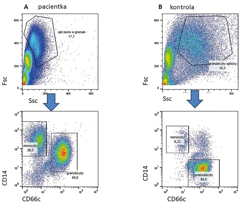 Ve sloupci A vlevo je nález u pacientky s prokázanou mutací v genu CEBPe. Je nápadná hypogranularita dle parametru SSc v horním grafu. Nelze dobře opticky podle parametrů Fsc a Ssc oddělit monocyty a granulocyty. V dolním grafu jsou zobrazeny buňky z gatu na horním obrázku. Je zřetelná populace monocytů CD14high CD66c negativní a granulocytů CD14 pozitivních a CD66c vysoce pozitivních. Vpravo zdravá kontrola.
