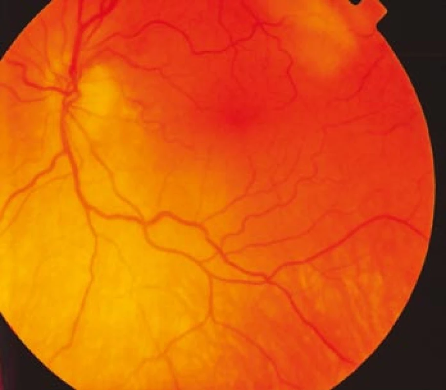 Fundus levého oka s bledší papilou terče zrakového nervu temporálně a lehce ne ostrými hranicemi.
