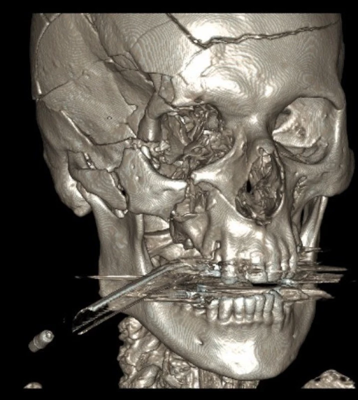 Na 3 D rekonstrukci CT snímků je patrná fisura čelní kosti, zlomenina zevního okraje orbity a zygomatického oblouku, imprese v oblasti velkého křídla kosti klínové