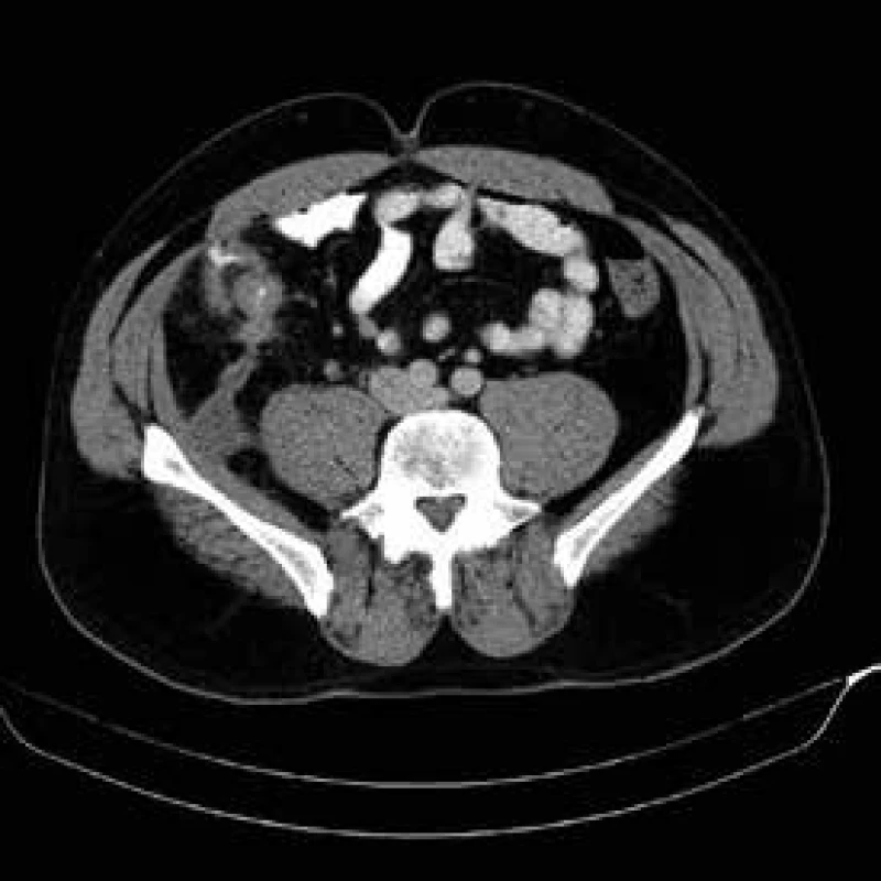 CT břicha – ileocékální postižení s píštělí a abscesem