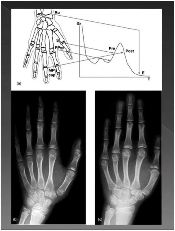 Detekce ukončení růstu kraniofaciálního skeletu pomocí RTG ruky. Upraveno podle: Op Heij D. G., Opdebeeck H., van Steenberghe D., Quirynen M.: Age as compromising factor for implant insertion. Periodontol 2000, 33, 2003, s. 172-184 [4].