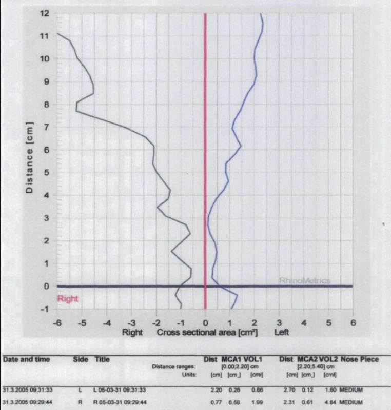 Záznam akustické rinometrie u nemocného s vybočenou nosní přepážkou doleva