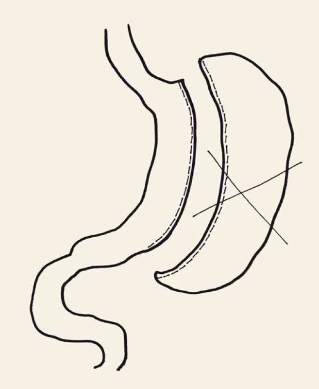 Rukávová resekce žaludku.
Fig.1. Sleeve gastrectomy.