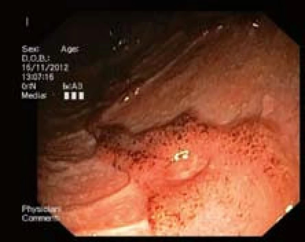 Těžká ulcerózní kolitida s rozsáhlými vředy.
Fig. 3. Serious ulcerative colitis with extensive ulcers.

