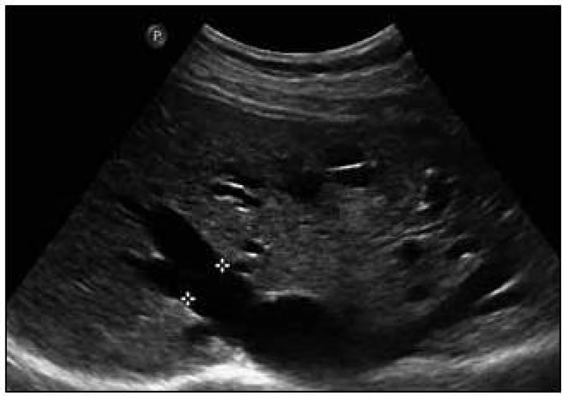 Sonografický obraz jaterních arteriovenózních malformací. Dilatované hepatické žíly (pravá v. hepatica 16 mm), v okolním parenchymu arteriovenózní spojky.