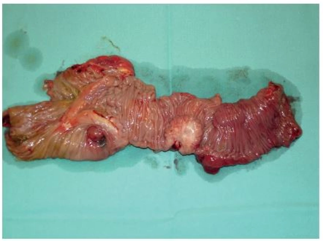 Rozstřižený resekát ileocekální oblasti, bělavé tumurózní ložisko s prokrvácením ve stěně terminálního ilea
Fig. 2: Ileocaecal resection, white tumour-like lesion with haemorrhage in the wall of the terminal intestine