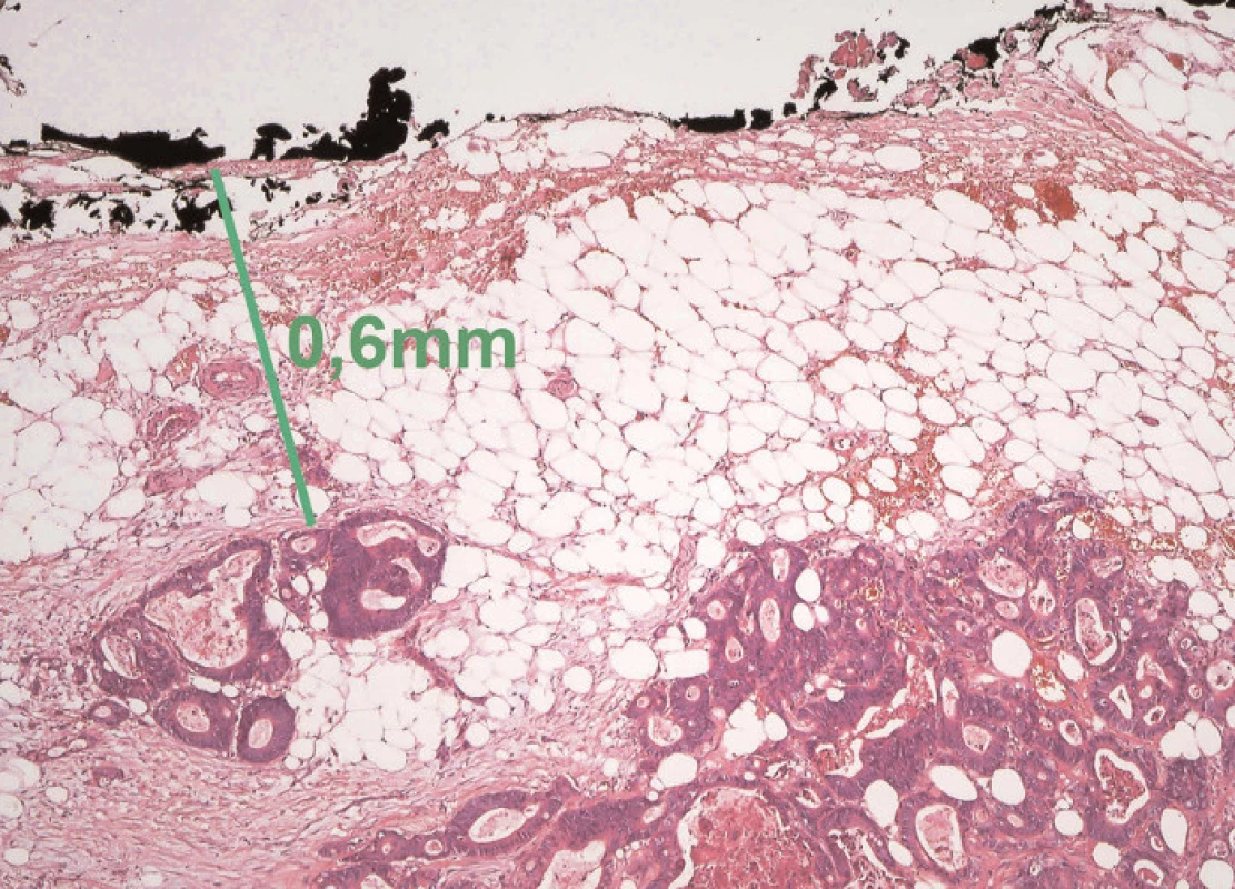 a) Příčná lamela z místa nádoru; nádorový infiltrát se blíží těsně k CRO (šipka), b) mikroskopicky stanovená vzdálenost nádorových žlázek od černě zvýrazněného CRO
Fig. 2: a) Transverse section of the resection specimen with tumour infiltration near the circular resection margin (CRM) (arrow), b) microscopic evaluation of the distance between tumour glands and inked CRM