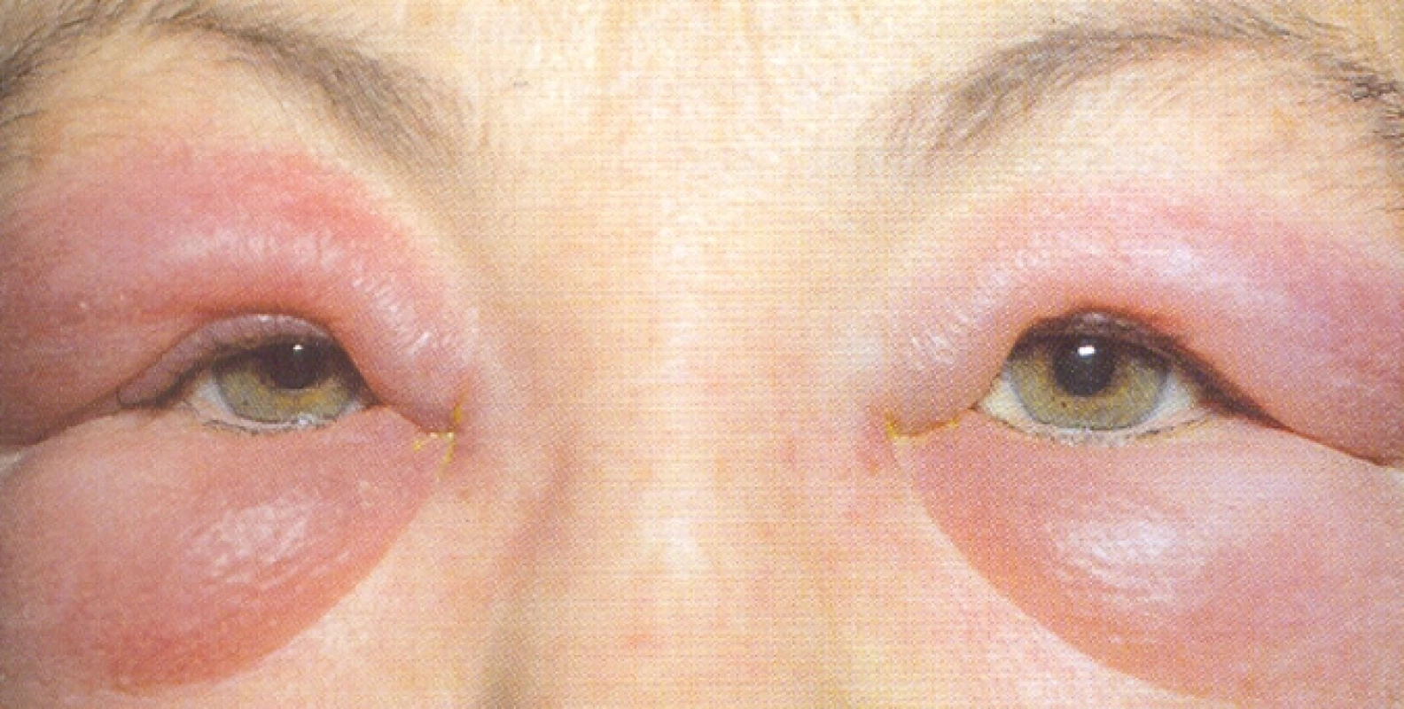 Alergická reakce periokulární kůže po lokální aplikaci léku