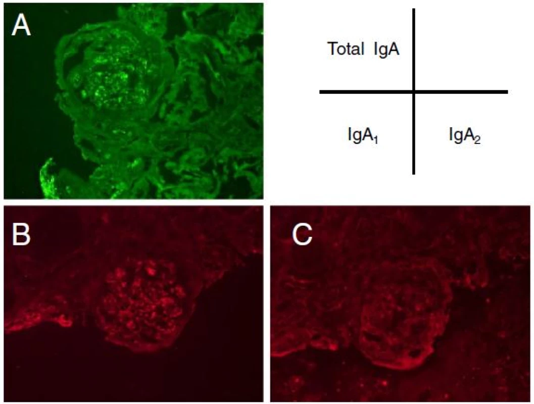 Immunofluorescent histological findings of the glomeruli. Immunostaining of total IgA (a), IgA&lt;sub&gt;1&lt;/sub&gt; (b), IgA&lt;sub&gt;2&lt;/sub&gt; (c) in kidney glomeruli