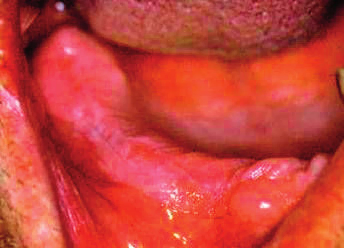 Homogenná leukoplakia na pravom alveolárnom hrebeni v rozsahu od prvého premolára až po tretí molár. Ide o následok uvoľnenej fixnej náhrady a jej mechanického dráždenia (Ďurovič)