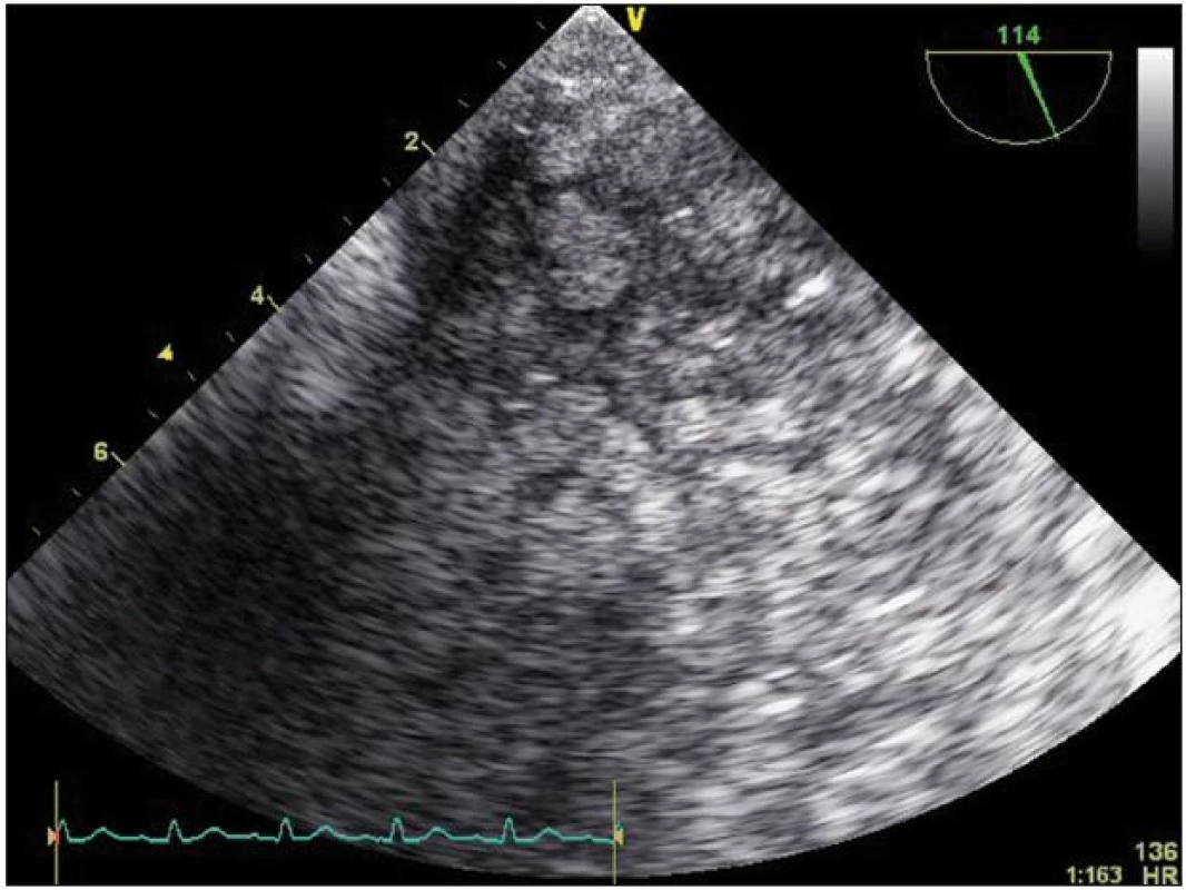 Hustě konzolidovaná tkáň plic zobrazená při transezofageálním ultrazvuku v průběhu kanylace pro ECMO.