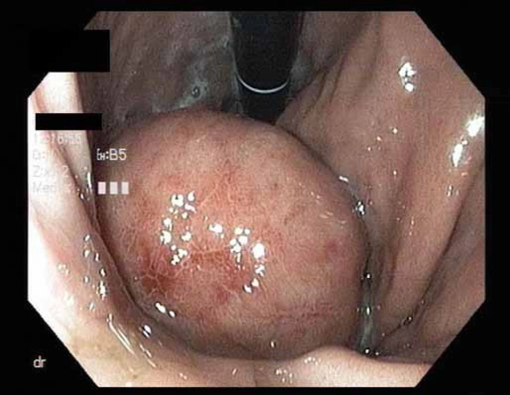 Endoskopický obraz submukózního nádoru v žaludku.
Fig. 1. Endoscopic image of submucosal tumor in the stomach.