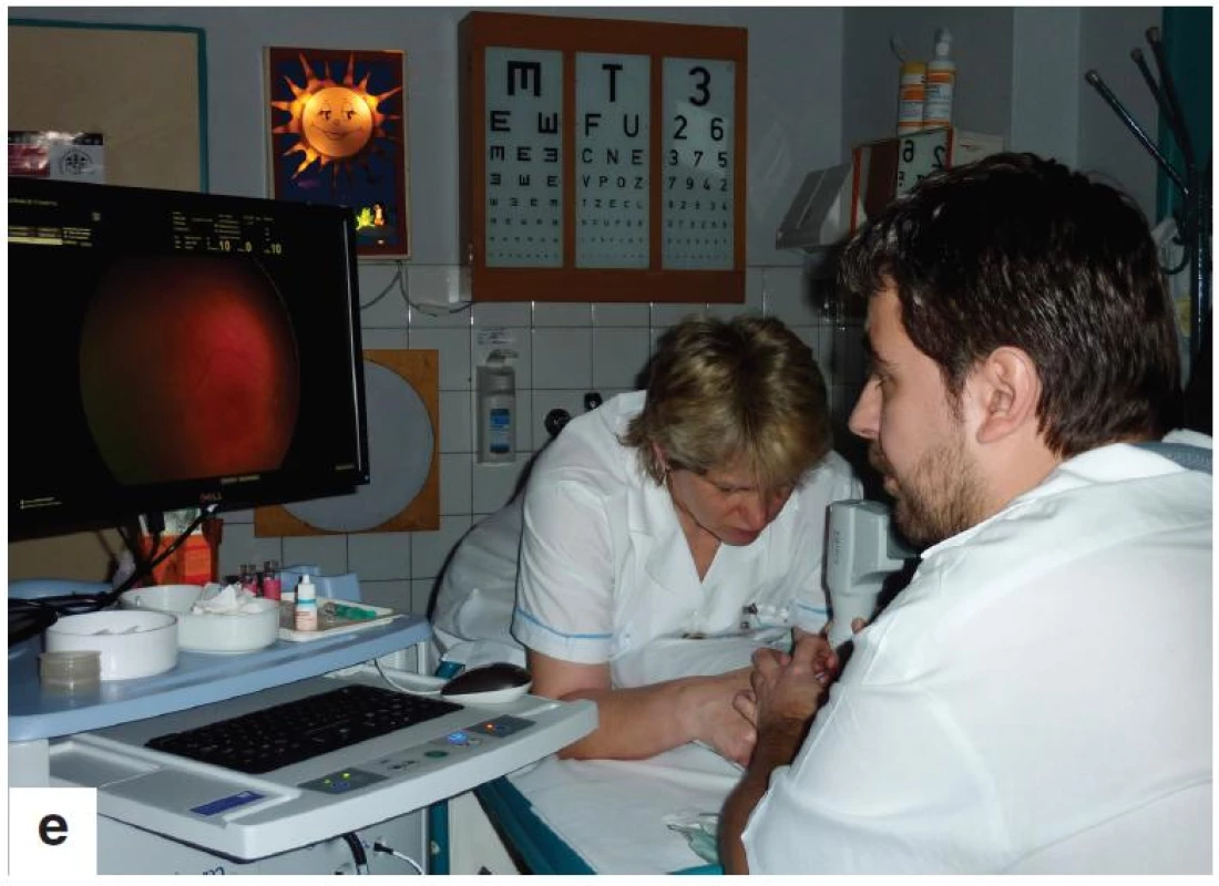 Oční vyšetření bylo u všech dětí provedeno v lokální instilační anestezii (obr. 1a), za použití víčkového rozvěrače (obr. 1b), v arteficiální mydriáze. Vyšetření očního pozadí indirektním oftalmoskopem s použitím 28D čočky a digitálním zobrazovacím systémem RetCam 3 (obr. 1c, d, e)