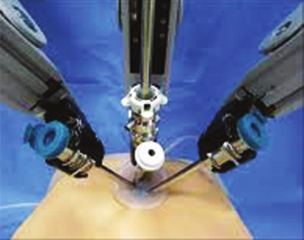 Single port robotická chirurgie
Fig. 6: Single-port robotic surgery