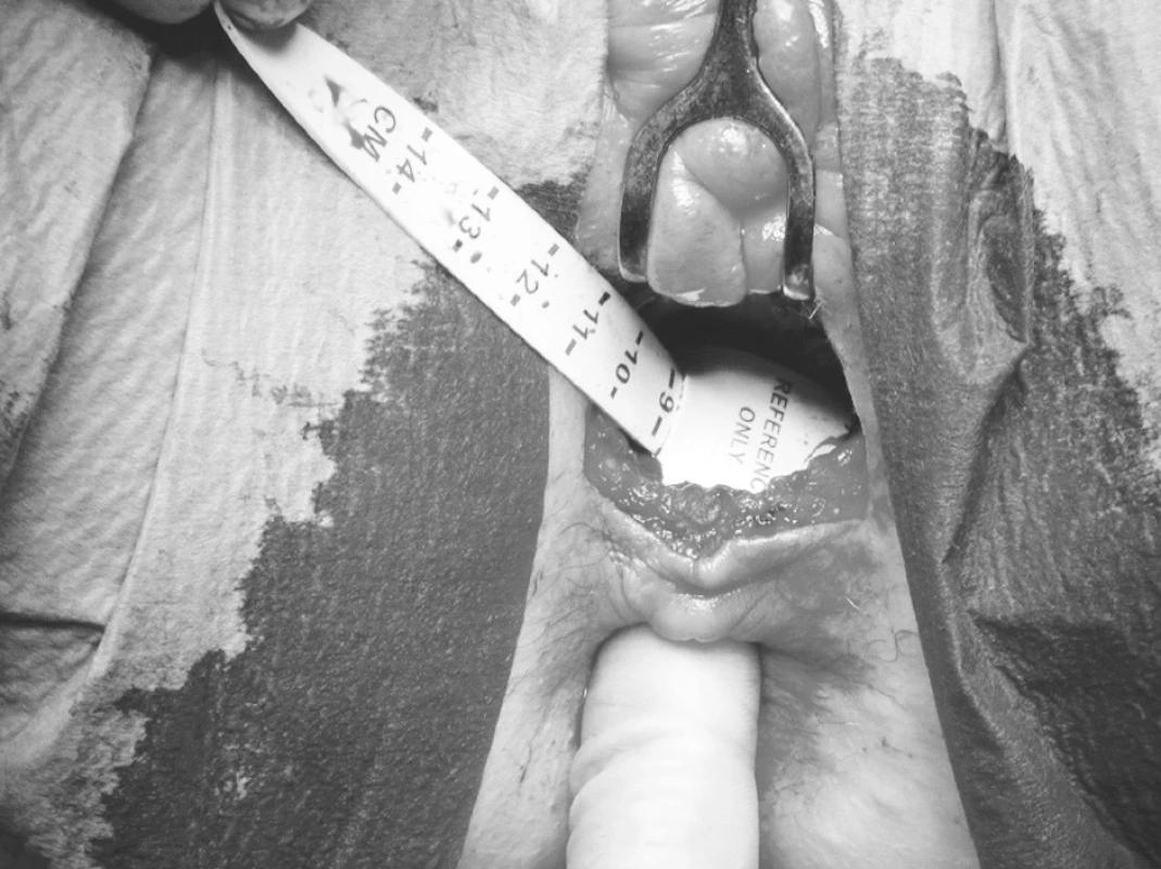 Peroperační snímek: kalibrace manžety umělého svěrače
Pic. 3. Situation during surgery: calibration of the cuff