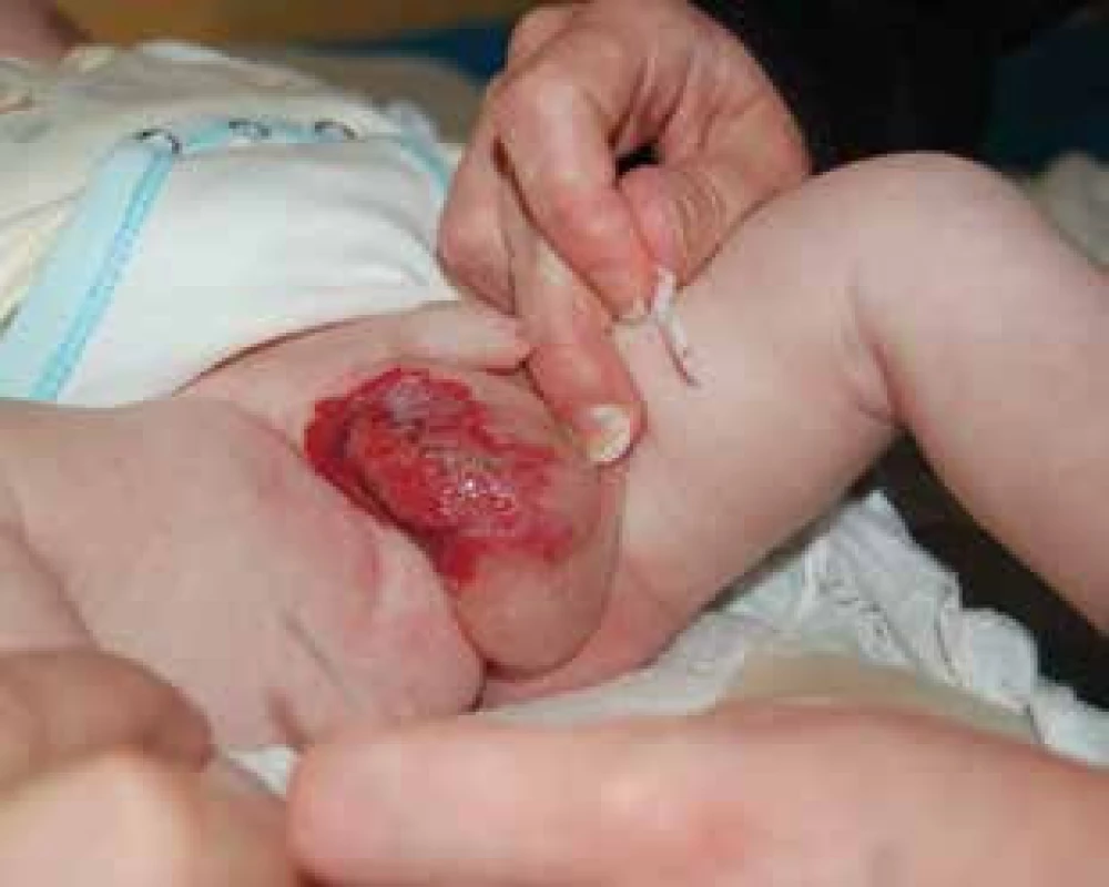 Ulcerovaný infantilní hemangiom skrota.
Fig. 9. Ulceration of scrotal infantile hemangioma.