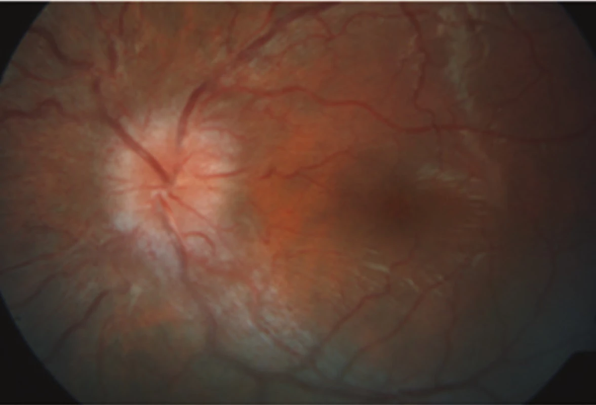 Zlepšující se nález s ustupujícím edémem terče zrakového nervu na levém oku 
po několika týdnech léčby