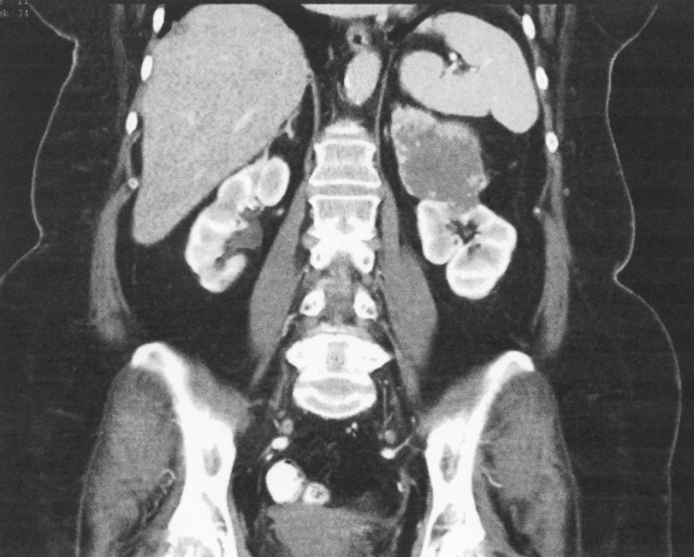 CT – koronární řez – obraz zobrazující tumor levé nadledviny. Histologicky karcinom kůry
Fig. 3. CT – coronary section – depicting a tumor of the left adrenal gland. Histology confirmed carcinoma of the adrenal cortex