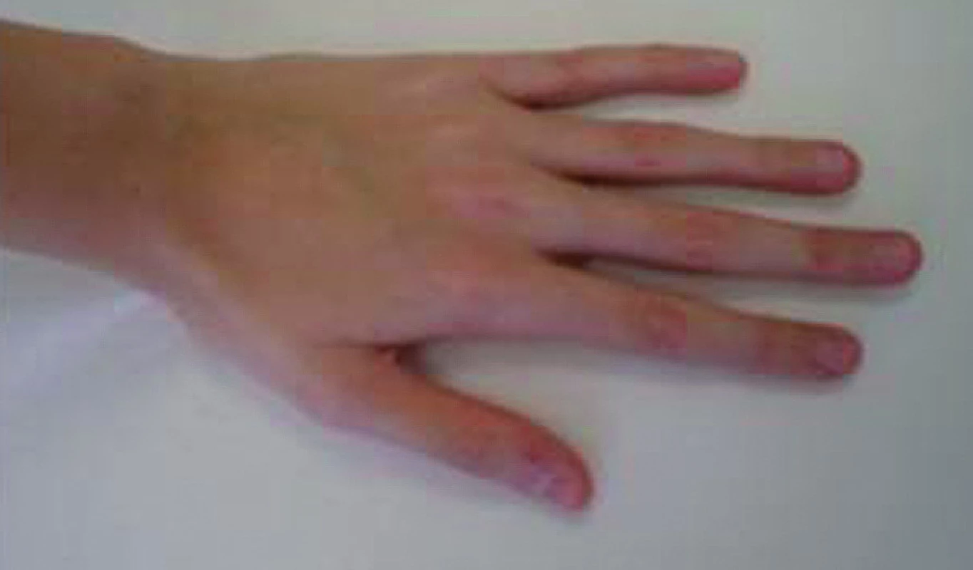 Ruka 11letého chlapce s Marfanovým syndromem. 
Typické jsou dlouhé štíhlé prsty. Chlapec roste od batolecího věku nad 97. percentilem tělesné výšky a má subluxaci očních čoček. Největším celoživotním rizikem je ruptura aortálního aneuryzmatu.