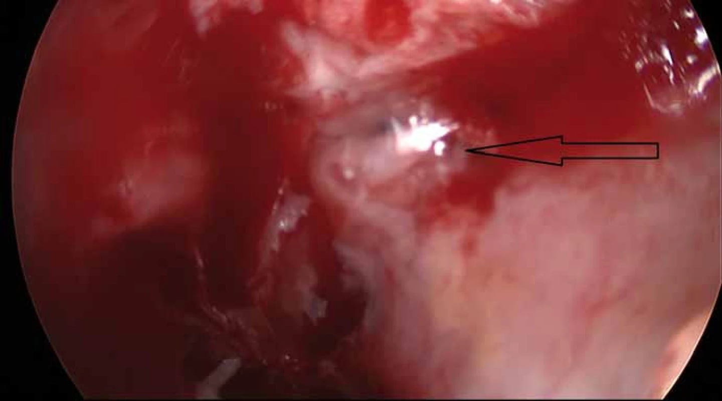 Peroperační snímek (Storz, Německo, 30° optika).
Únik mozkomíšního moku z oblasti rinobaze po odloučení sliznice.