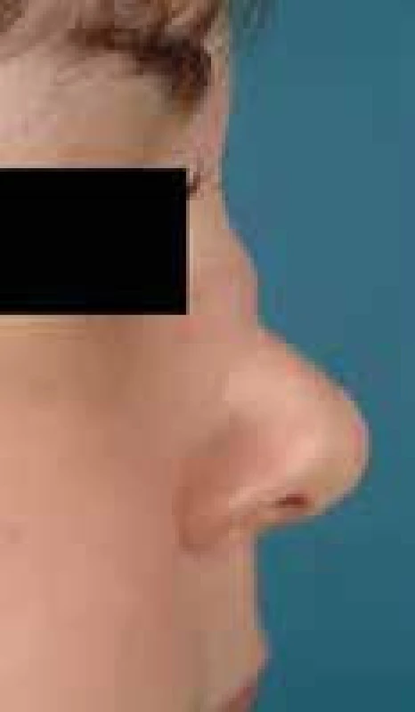 Granulomatóza s polyangiitidou – sedlovitý nos