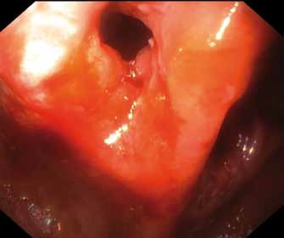 Pouchoskopie – stenóza anu se susp. píštělí v pouchanální anastomóze.