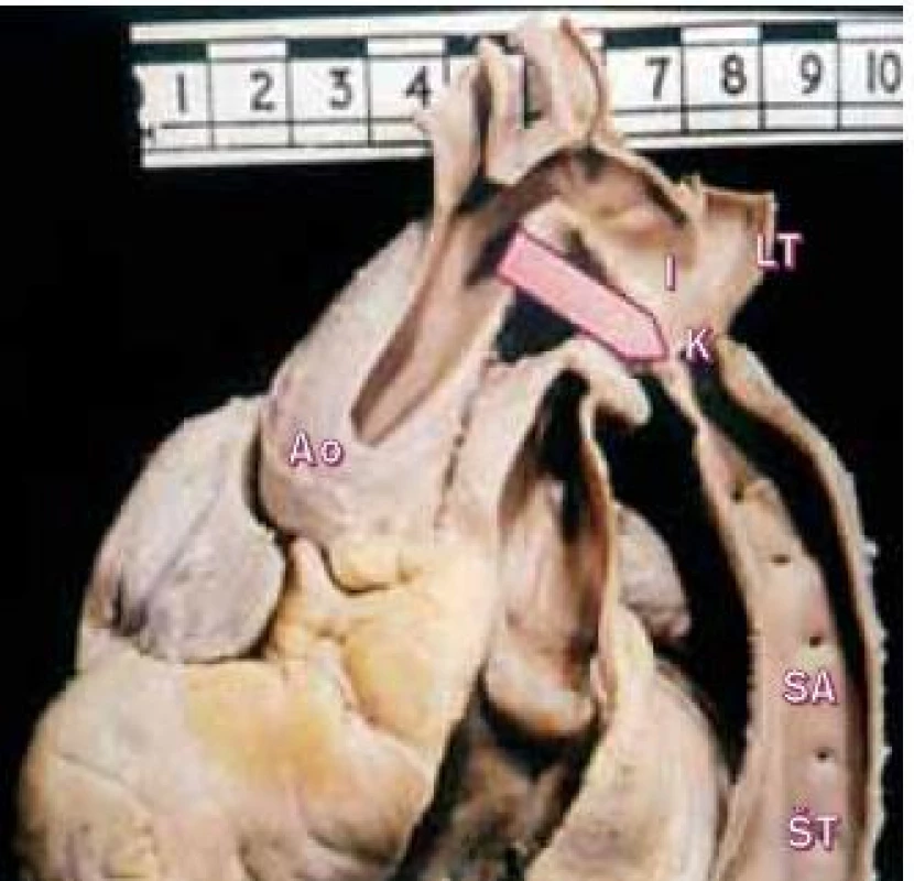 Pohled na tepny aortálního oblouku a koarktaci aorty (šipka) lokalizovanou právě pod levou podklíčkovou tepnou. Ústí interkostálních tepen jsou široká.