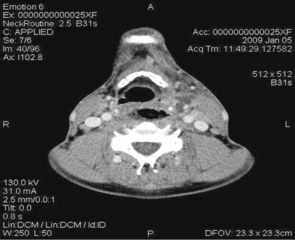 Horizontální CT s kontrastem v úrovni jazylky – vícečetná abscesová ložiska v parafaryngeálním prostoru ventrálně od velkých cév.