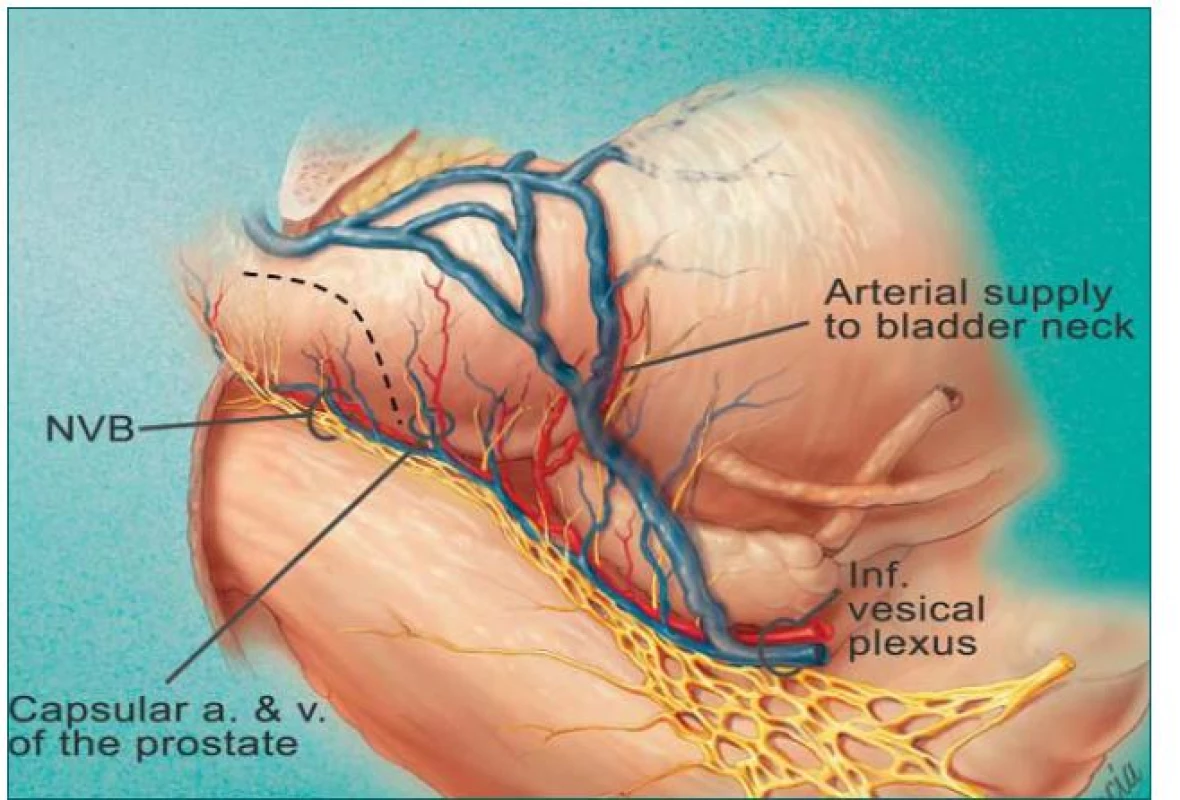 Schéma nové techniky uvolnění nervově cévních svazků při otevřené radikální prostatektomii (poskytující srovnatelné výsledky zachování erekce s Menonovou technikou, ale při zachování onkologické bezpečnosti).