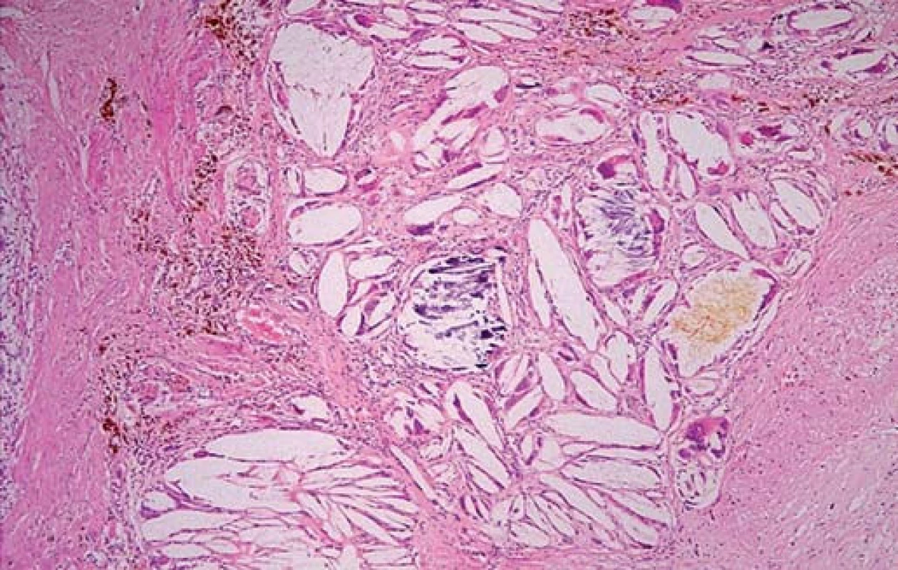 Cholesterolofagický granulom – ložisko sestává z obrovských mnohojaderných buněk, které fagocytují či opouzdřují krystaly cholesterolu (vzhledem k rozpuštění cholesterolu v průběhu zpracování tkáně jsou patrny pouze prázdné prostory). Dále jsou přítomny drobné dystrofické kalcifikace fialové barvy (uprosřed) a malé množství žluté žluči (Hematoxylin-eozin).
Fig. 4. Cholesterol granuloma – the site consists of giant multinucleated cells that are phagocytizing or encapsulating cholesterol crystals (only empty spaces are visible as the cholesterol has melted away during tissue processing). Small purple dystrophic calcifications are also visible (in the middle), as well as a small amount of yellow bile (Hematoxylin and eosin staining).