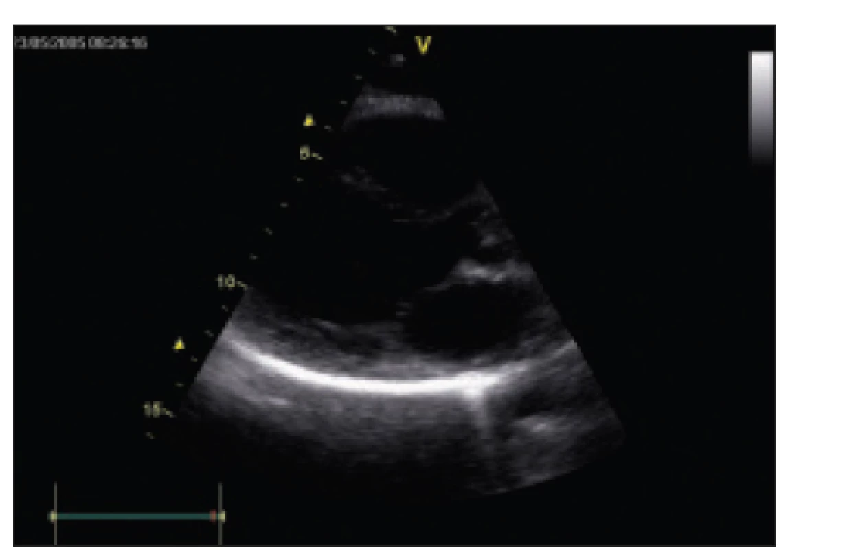 Echokardiografický nález u pacientky 1 po fenestraci perikardu bez nálezu výpotku. Parasternální dlouhá osa, 2rozměrné zobrazení.