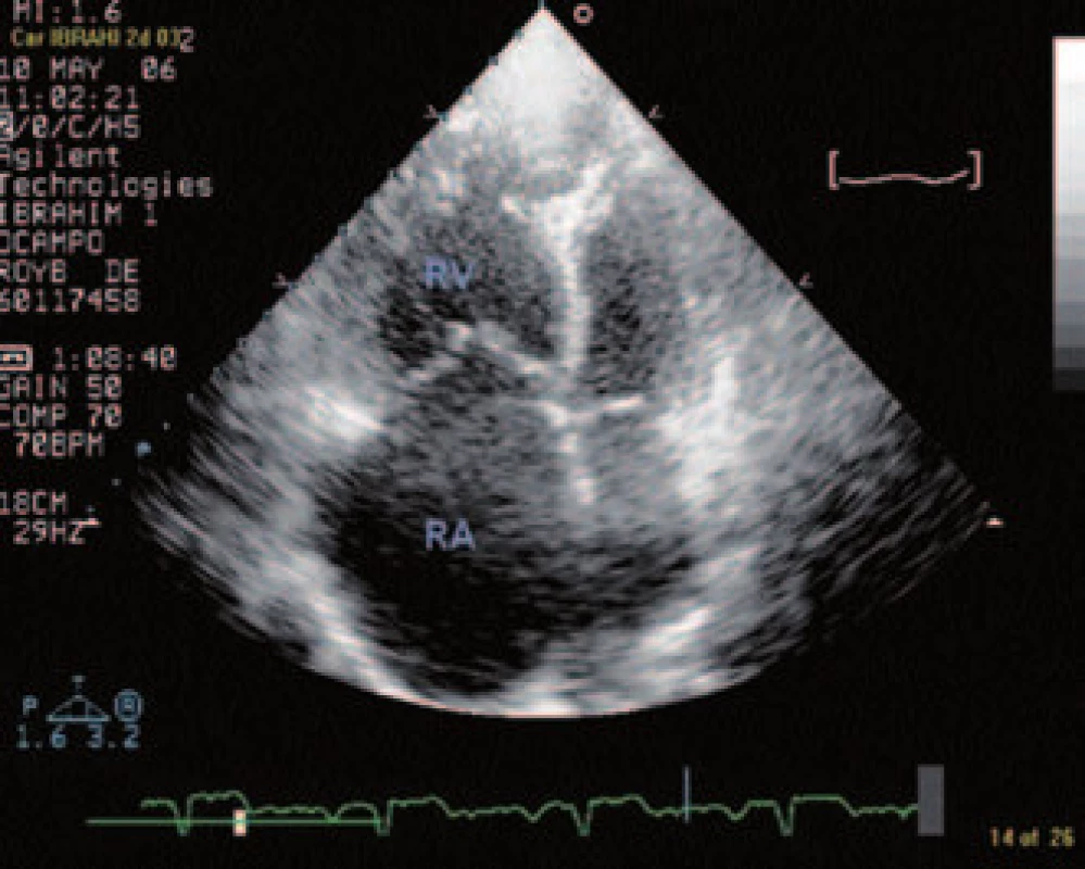 Transtorakálne echokardiografické vyšetrenie – dilatácia dutín pravého srdca.