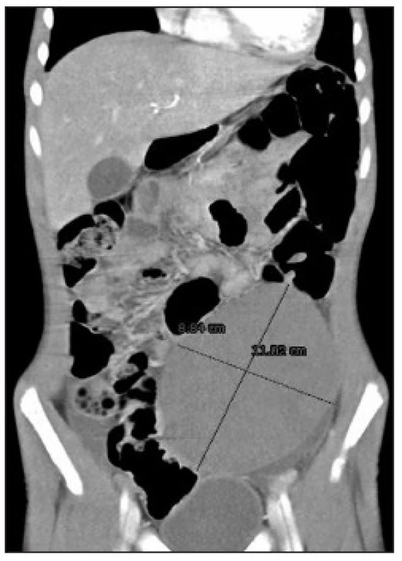 CT obraz dystopickej sleziny sferoidneho tvaru
Fig. 3. CT image of dystopic spheroidal spleen