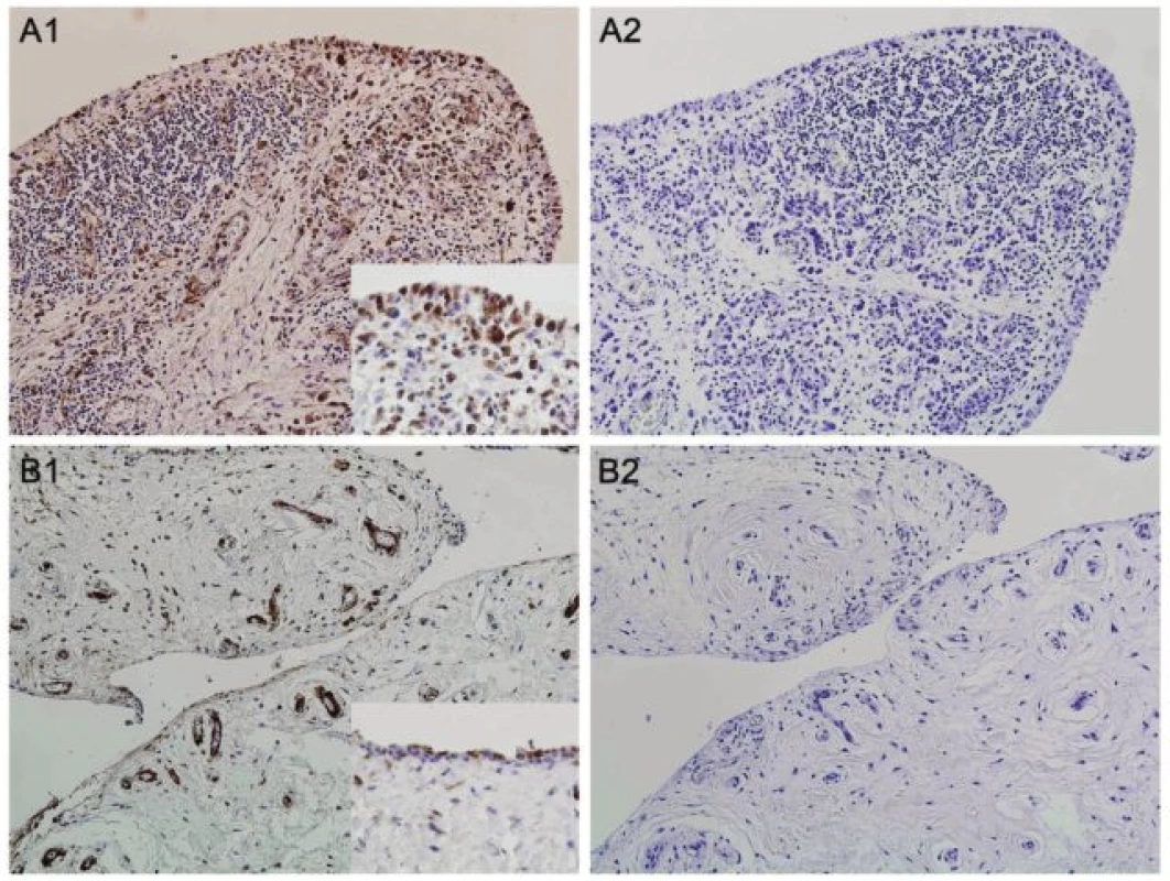 Exprese proteinu vázajícího mastné kyseliny-4 (FABP4) v synoviální tkáni pacientů s revmatoidní artritidou (RA) (A1) a osteoartrózou (OA) (B1). Největší intenzita barvení byla přítomna v mononukleárních buňkách zánětlivého infiltrátu RA synoviální tkáně. Cévy, kapiláry a tuková tkáň se barvila ve srovnatelné intenzitě u obou skupin. Izotypová kontrola (myší IgG) byla použita jako negativní kontrola (A2, B2). Originální zvětšení 100x, detail v rámečku 400x.