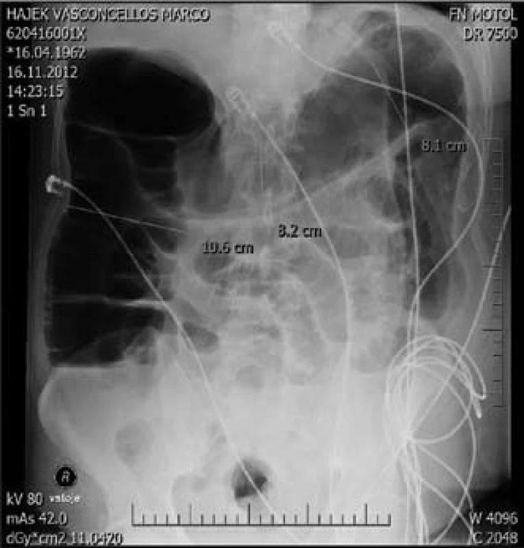 Nativní snímek břicha ve­stoje – megakolon.
Fig. 6. Megacolon (X-rays image).
