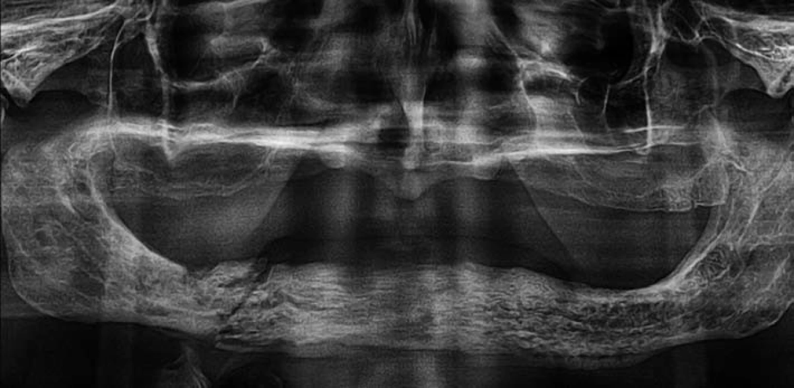 Ortopantomogram pacienta z obr. 1 – nehomogenní struktura kosti dolní čelisti se sklerózou především ve frontálním úseku a v těle vpravo. Dále je jasně patrná patologická zlomenina v těle dolní čelisti vpravo bez výraznější dislokace, při dolní hraně čelisti je viditelná osifikovaná periostální reakce.