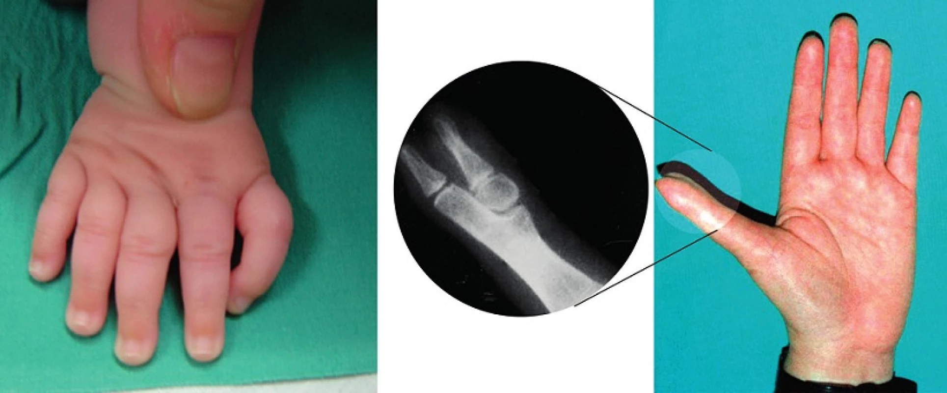 Anomálie typické pro pacienty s Fanconiho anémií a Diamondovou-Blackfanovou anémií: trifalangeální palec, hypoplazie thenarového svalstva.